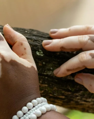 Otoimmün hastalıkların yönetimi