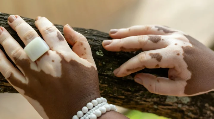 Otoimmün hastalıkların yönetimi